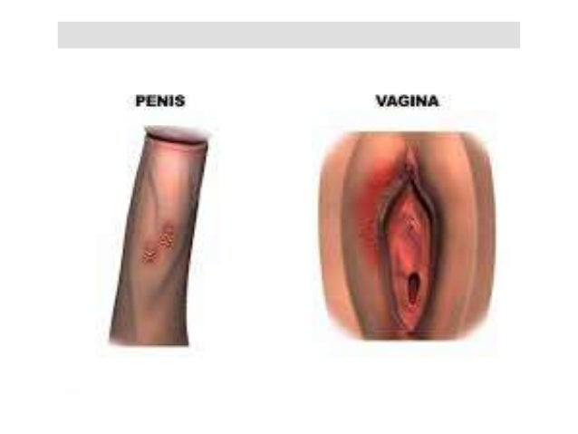 pictures of herpes on vagina #10