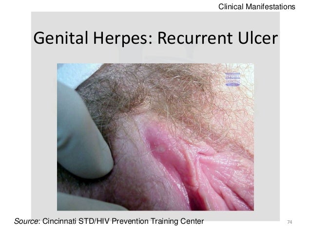 genital herpes ulcers pictures #10