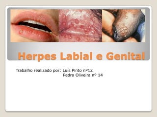 Herpes Labial e Genital
Trabalho realizado por: Luís Pinto nº12
Pedro Oliveira nº 14

 