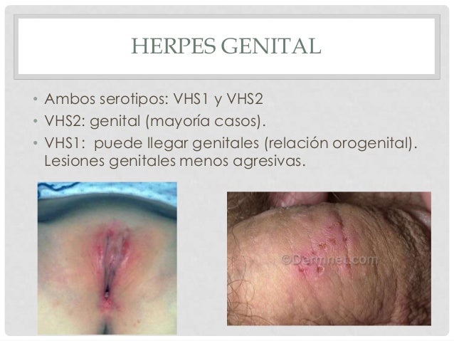 Genital Herpes (HSV-2) Facts and Photos | STDs In Color