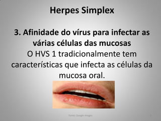 Herpes Simplex
3. Afinidade do vírus para infectar as
várias células das mucosas
O HVS 1 tradicionalmente tem
características que infecta as células da
mucosa oral.
Fonte: Google Images 6
 