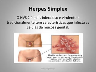 Herpes Simplex
O HVS 2 é mais infeccioso e virulento e
tradicionalmente tem características que infecta as
celulas da mucosa genital.
Fonte: Google Images 7
 