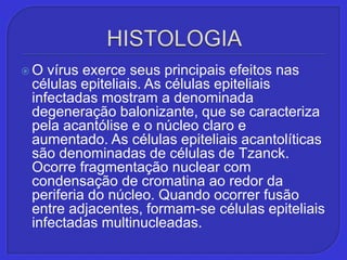HISTOLOGIAO vírus exerce seus principais efeitos nas células epiteliais. As células epiteliais infectadas mostram a denominada degeneração balonizante, que se caracteriza pela acantólise e o núcleo claro e aumentado. As células epiteliais acantolíticas são denominadas de células de Tzanck. Ocorre fragmentação nuclear com condensação de cromatina ao redor da periferia do núcleo. Quando ocorrer fusão entre adjacentes, formam-se células epiteliais infectadas multinucleadas.