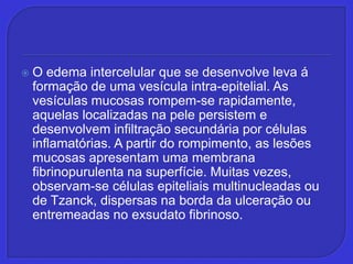 O edema intercelular que se desenvolve leva á formação de uma vesícula intra-epitelial. As vesículas mucosas rompem-se rapidamente, aquelas localizadas na pele persistem e desenvolvem infiltração secundária por células inflamatórias. A partir do rompimento, as lesões mucosas apresentam uma membrana fibrinopurulenta na superfície. Muitas vezes, observam-se células epiteliais multinucleadas ou de Tzanck, dispersas na borda da ulceração ou entremeadas no exsudatofibrinoso.  