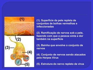 (1). Superfície da pele repleta de conjuntos de bolhas vermelhas e infeccionadas (2). Ramificação de nervos sob a pele, fazendo com que a pessoa sinta a dor também na superfície (3). Bainha que envolve o conjunto de nervos (4). Conjunto de nervos sendo atacados pelo Herpes Vírus (5). Estrutura do nervo repleto de vírus 