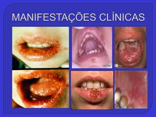 MANIFESTAÇÕES CLÍNICAS