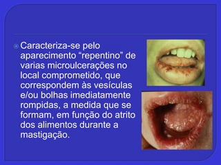 Caracteriza-se pelo aparecimento “repentino” de varias microulcerações no local comprometido, que correspondem às vesículas e/ou bolhas imediatamente rompidas, a medida que se formam, em função do atrito dos alimentos durante a mastigação. 