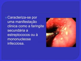 Caracteriza-se por uma manifestação clinica como a faringite secundária a estreptococos ou à mononucleose infecciosa.