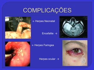 COMPLICAÇÕES←Herpes Neonatal    Encefalite  ->← Herpes FaringeaHerpes ocular  ->