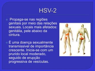 HSV-2 Propaga-se nas regiões genitais por meio das relações sexuais. Locais mais afetados: genitália, pele abaixo da cintura.È uma doença sexualmente transmissivel de importância crescente. Inicia-se com um prurido local moderado, seguido de erupção progressiva de vesículas.