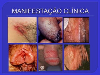 MANIFESTAÇÃO CLÍNICA
