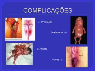 COMPLICAÇÕES←ProstatiteNatimorto  ->← AbortoVulvite  ->