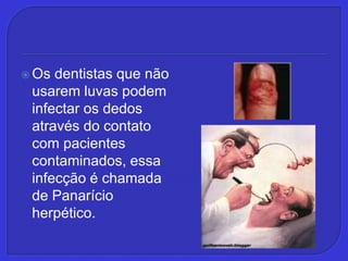 Os dentistas que não usarem luvas podem infectar os dedos através do contato com pacientes contaminados, essa infecção é chamada de Panarício herpético.
