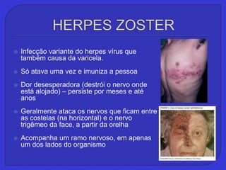 HERPES ZOSTERInfecção variante do herpes vírus que também causa da varicela.Só atava uma vez e imuniza a pessoaDor desesperadora (destrói o nervo onde está alojado) – persiste por meses e até anosGeralmente ataca os nervos que ficam entre as costelas (na horizontal) e o nervo trigêmeo da face, a partir da orelhaAcompanha um ramo nervoso, em apenas um dos lados do organismo