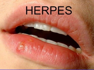 HERPES,[object Object]