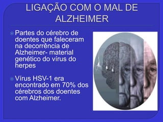 LIGAÇÃO COM O MAL DE ALZHEIMER,[object Object],Partes do cérebro de doentes que faleceram na decorrência de Alzheimer- material genético do vírus do herpes,[object Object],Vírus HSV-1 era encontrado em 70% dos cérebros dos doentes com Alzheimer.,[object Object]