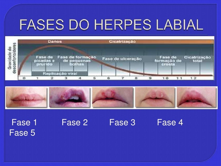 Herpes (seminário)