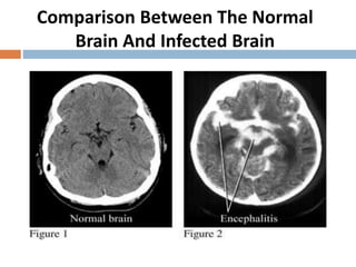 Comparison Between The Normal
Brain And Infected Brain
 