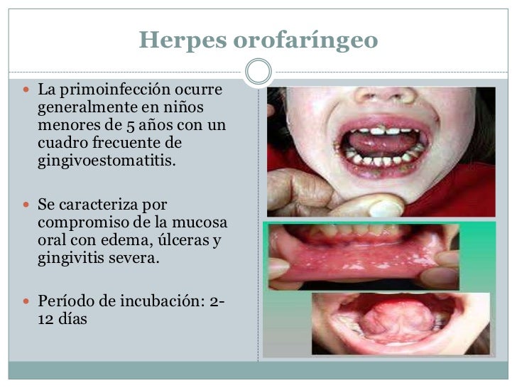 Herpes Simple