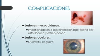 COMPLICACIONES
Lesiones mucocutáneas:
Impetiginización o sobreinfección bacteriana por
estafilococo y estreptococo
Lesiones oculares:
Queratitis, ceguera
 