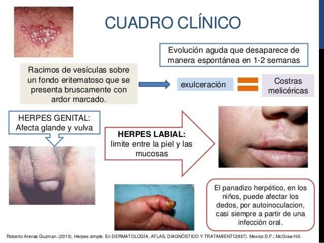 Herpes Simple