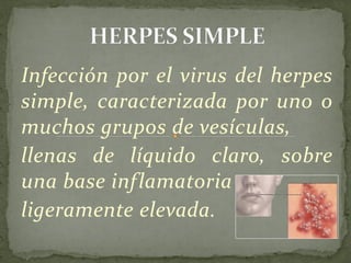 Infección por el virus del herpes
simple, caracterizada por uno o
muchos grupos de vesículas,
llenas de líquido claro, sobre
una base inflamatoria
ligeramente elevada.
 