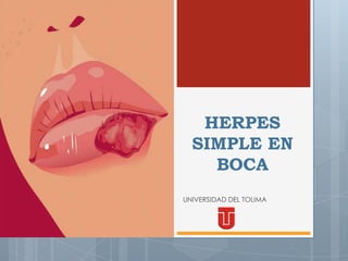 HERPES
  SIMPLE EN
    BOCA
UNIVERSIDAD DEL TOLIMA
 