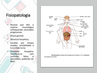 Pública
Fisiopatologia
• Pessoas que têm o
sistema imunológico
enfraquecido: ulcerações
progressivas.
• Úlcera genital;
• Panarício herpético;
• Ceratite por herpes
simples: sensibilidade à
luz e visão turva.
• Encefalite herpética:
manifesta-se com
confusão, febre e
convulsões, podendo ser
fatal.
 
