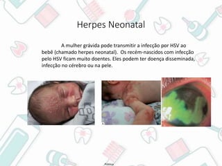 Pública
Herpes Neonatal
A mulher grávida pode transmitir a infecção por HSV ao
bebê (chamado herpes neonatal). Os recém-nascidos com infecção
pelo HSV ficam muito doentes. Eles podem ter doença disseminada,
infecção no cérebro ou na pele.
 