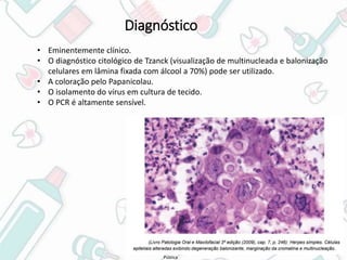 Pública
Diagnóstico
• Eminentemente clínico.
• O diagnóstico citológico de Tzanck (visualização de multinucleada e balonização
celulares em lâmina fixada com álcool a 70%) pode ser utilizado.
• A coloração pelo Papanicolau.
• O isolamento do vírus em cultura de tecido.
• O PCR é altamente sensível.
 