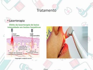 Pública
Tratamento
• Laserterapia
 