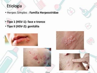 Pública
Etiologia
• Herpes Simples : Família Herpesviridae
• Tipo 1 (HSV-1): face e tronco
• Tipo II (HSV-2): genitália
 