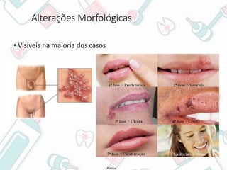 Pública
Alterações Morfológicas
• Visíveis na maioria dos casos
 