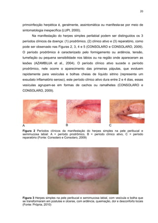 20



primoinfecção herpética é, geralmente, assintomática ou manifesta-se por meio de
sintomatologia inespecífica (LUPI, 2000).
      Na manifestação do herpes simples perilabial podem ser distinguidos os 3
períodos clínicos da doença: (1) prodrômico, (2) clínico ativo e (3) reparatório, como
pode ser observado nas Figuras 2, 3, 4 e 5 (CONSOLARO e CONSOLARO, 2009).
O período prodrômico é caracterizado pelo formigamento ou ardência, tensão,
tumefação ou pequena sensibilidade nos lábios ou na região onde apareceram as
lesões (AZAMBUJA et al., 2004). O período clínico ativo sucede o período
prodrômico, nele ocorre o aparecimento das primeiras pápulas, que evoluem
rapidamente para vesículas e bolhas cheias de líquido sitrino (representa um
exsudato inflamatório seroso), este período clínico ativo dura entre 2 e 4 dias, essas
vesículas agrupam-se em formas de cachos ou ramalhetes (CONSOLARO e
CONSOLARO, 2009).




A                              B                               C
Figura 2 Períodos clínicos da manifestação do herpes simples na pele peribucal e
semimucosa labial: A = período prodrômico, B = período clínico ativo, C = período
reparatório (Fonte: Consolaro e Consolaro, 2009)




Figura 3 Herpes simples na pele peribucal e semimucosa labial, com vesícula e bolha que
se transformaram em pústulas e úlceras, com ardência, queimação, dor e desconforto locais
(Fonte: Própria, 2010)
 
