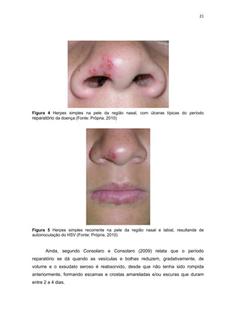 21




Figura 4 Herpes simples na pele da região nasal, com úlceras típicas do período
reparatório da doença (Fonte: Própria, 2010)




Figura 5 Herpes simples recorrente na pele da região nasal e labial, resultande de
autoinoculação do HSV (Fonte: Própria, 2010)


      Ainda, segundo Consolaro e Consolaro (2009) relata que o período
reparatório se dá quando as vesículas e bolhas reduzem, gradativamente, de
volume e o exsudato seroso é reabsorvido, desde que não tenha sido rompida
anteriormente, formando escamas e crostas amareladas e/ou escuras que duram
entre 2 a 4 dias.
 