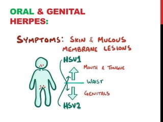 Herpes simplex infection(Hsv) | PPT