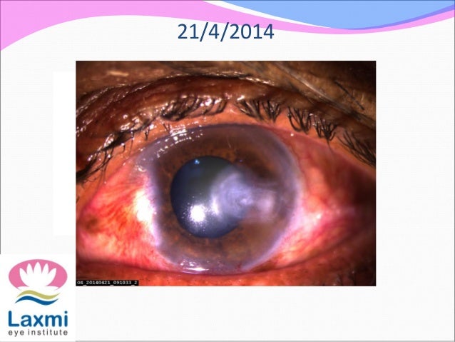 Herpes Simplex Keratitis Herpes Zoster Opthalmicus