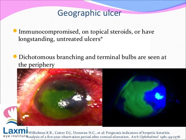 Herpes simplex keratitis & herpes zoster opthalmicus
