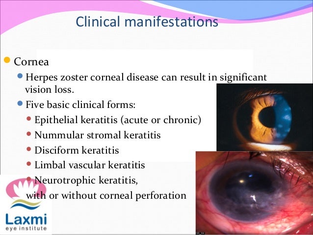 Herpes Simplex Keratitis Herpes Zoster Opthalmicus