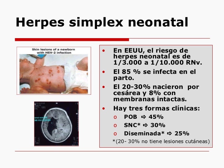 Herpes simplex perinatal