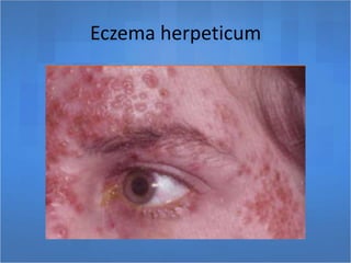 Eczema herpeticum
 
