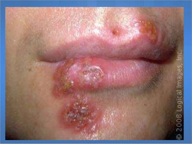Herpes Simplex Virus