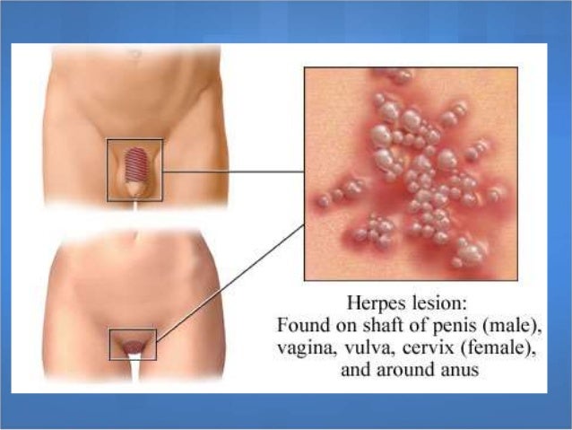 Herpes Zoster Picture Image on MedicineNet.com