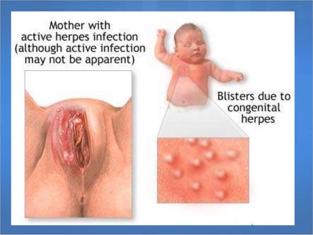 Syphilis - Image of Chancre, Oral - Centers for Disease ...