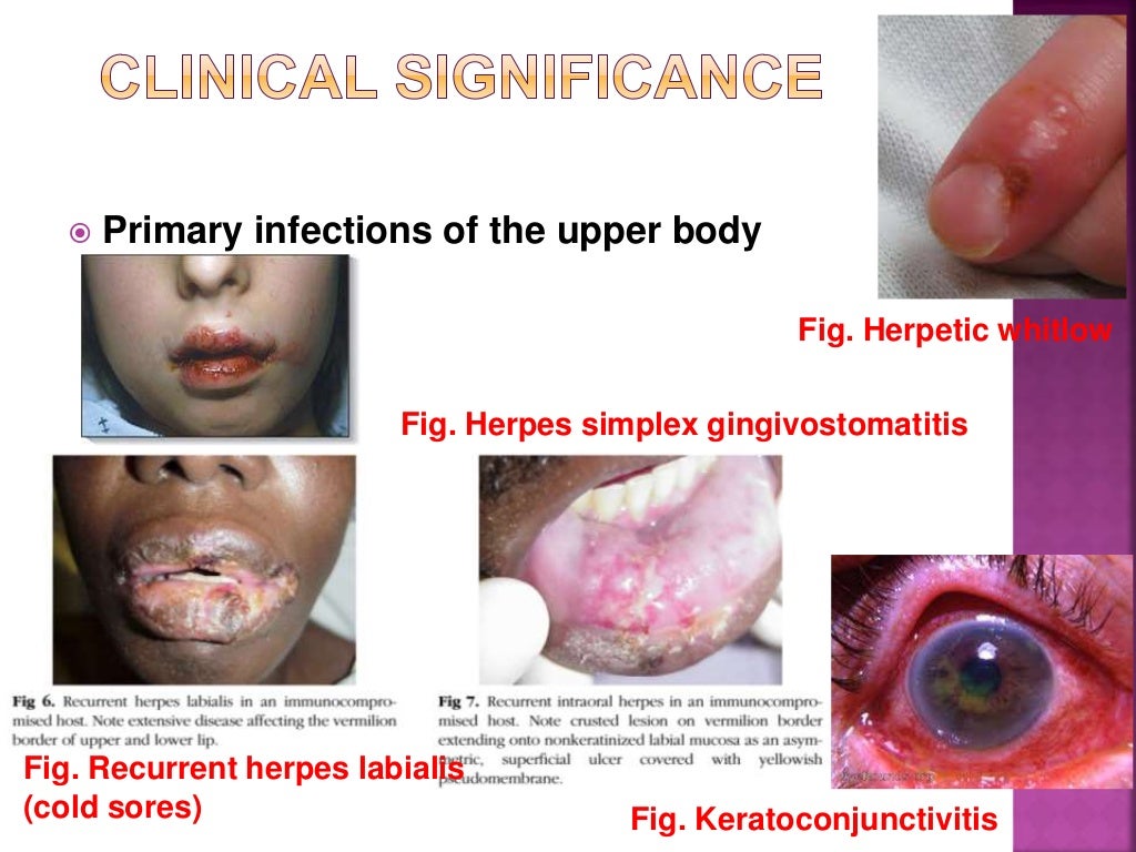 clinical presentation of herpes simplex virus