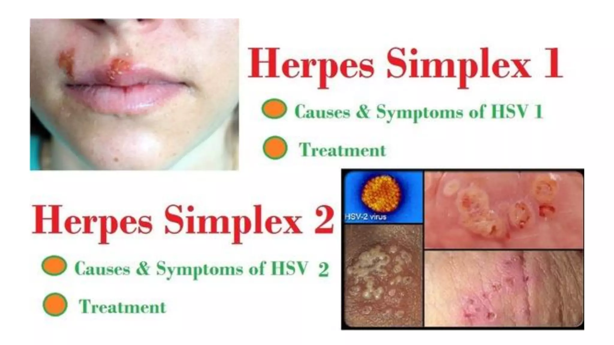 Herpes Simplex Virus PDF