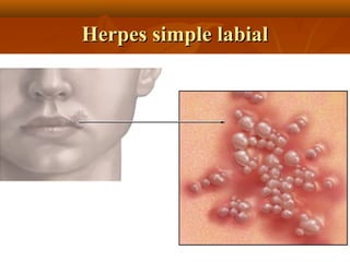 Herpes simple labial

 