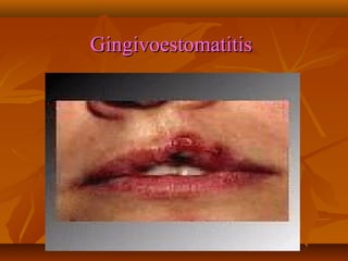 Gingivoestomatitis

 