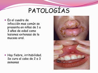 PATOLOGÍAS
 Es el cuadro de
  infección mas común se
  presenta en niños de 1 a
  3 años de edad como
  lesiones extensas de la
  mucosa oral.




 Hay fiebre, irritabilidad.
  Se cura al cabo de 2 a 3
  semanas
 
