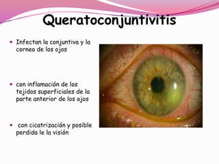 Queratoconjuntivitis
 Infectan la conjuntiva y la
  cornea de los ojos




 con inflamación de los
  tejidos superficiales de la
  parte anterior de los ojos



 con cicatrización y posible
  perdida le la visión
 